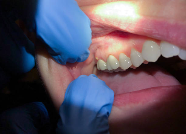 Best Urgent Care for Lost Fillings or Crowns in Lake Arrowhead, CA