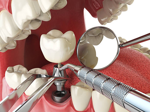 Best Emergency Root Canal Treatment in Lake Arrowhead, CA